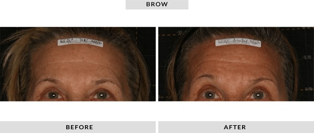 Sofwave Before and After Brow 3