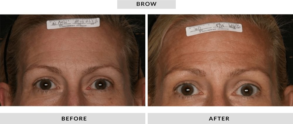 Sofwave Before and After Brow 4