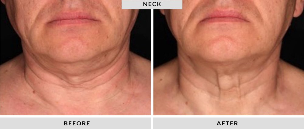 Sofwave Before and After Neck 1