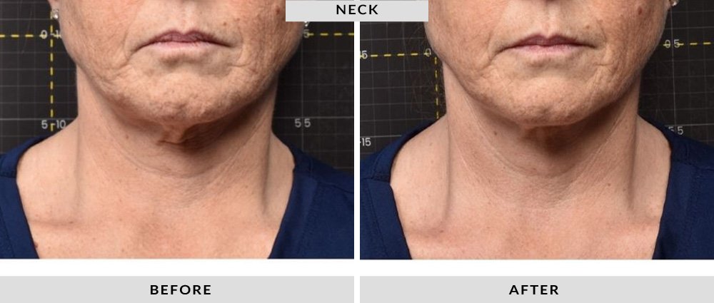 Sofwave Before and After Neck 2
