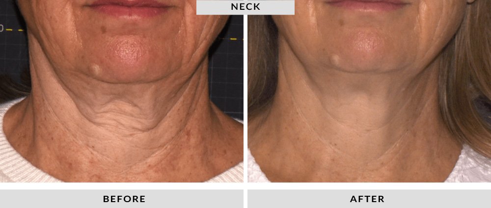 Sofwave Before and After Neck 3
