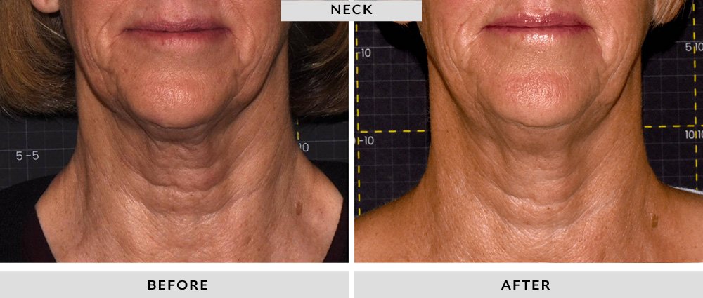 Sofwave Before and After Neck 4