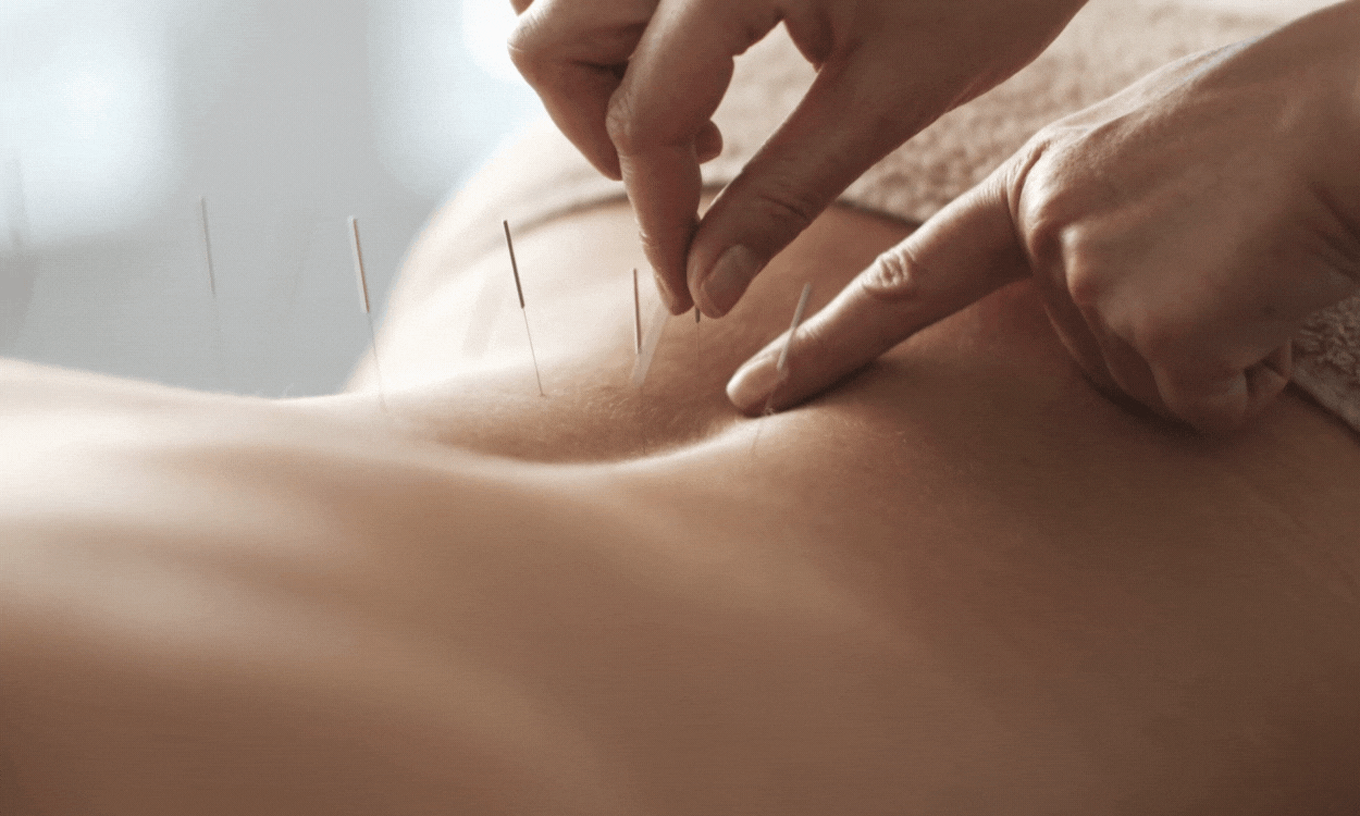 Acupuncture on Back