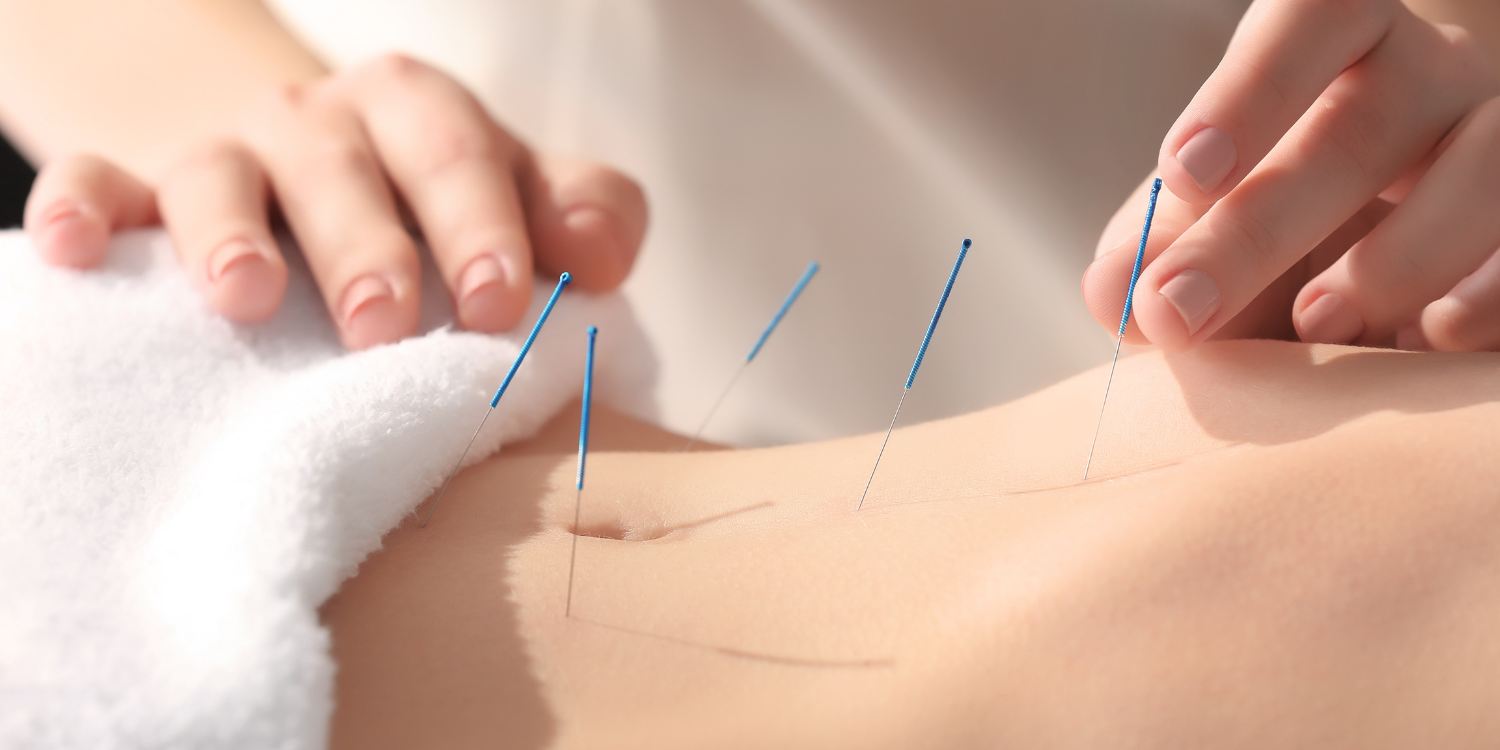 Person receiving acupuncture treatment on their back, with several acupuncture needles inserted into their skin.