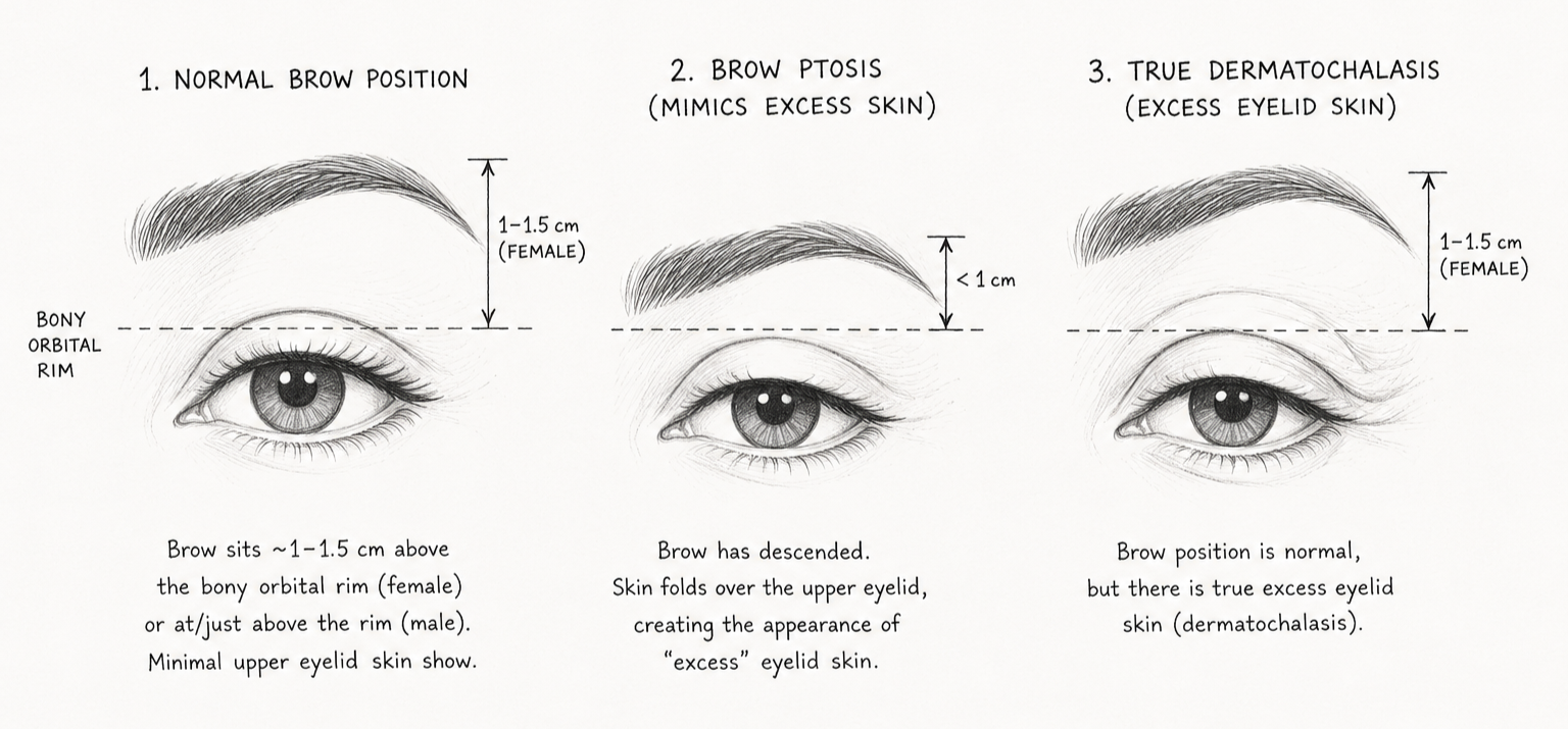 Sketch explaining the difference between brow ptosis and true dermatochalasis