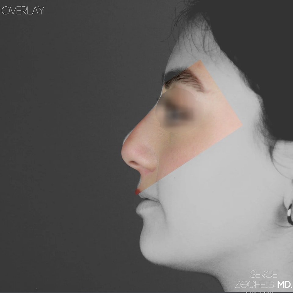 In this overlay, I show you how the power of a well-planned #rhinoplasty lies in subtle precision. A subtle detail can completely transform a face. In #preservationrhinoplasty, the nasal hump was dropped inside the nose using a #pushdown  technique, 