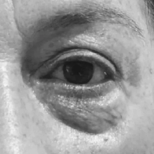 Eyelid Revision Surgery - Managing Unintended Consequences