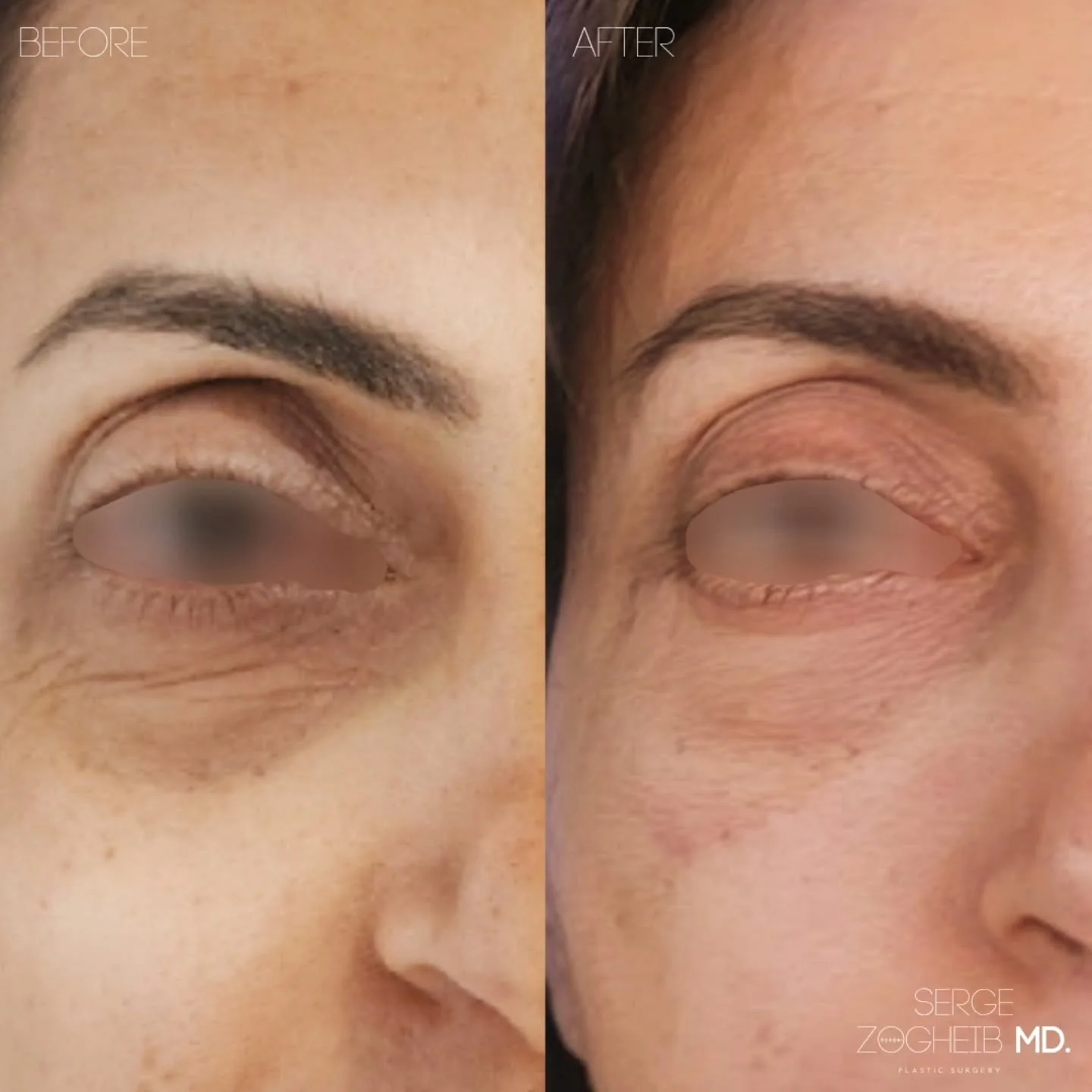 It&rsquo;s always humbling when patients trust me with their surgery.
But it&rsquo;s something else entirely when my own staff place their faces in my hands.

For my patient manager, I performed a lower blepharoplasty with fat transposition to treat 