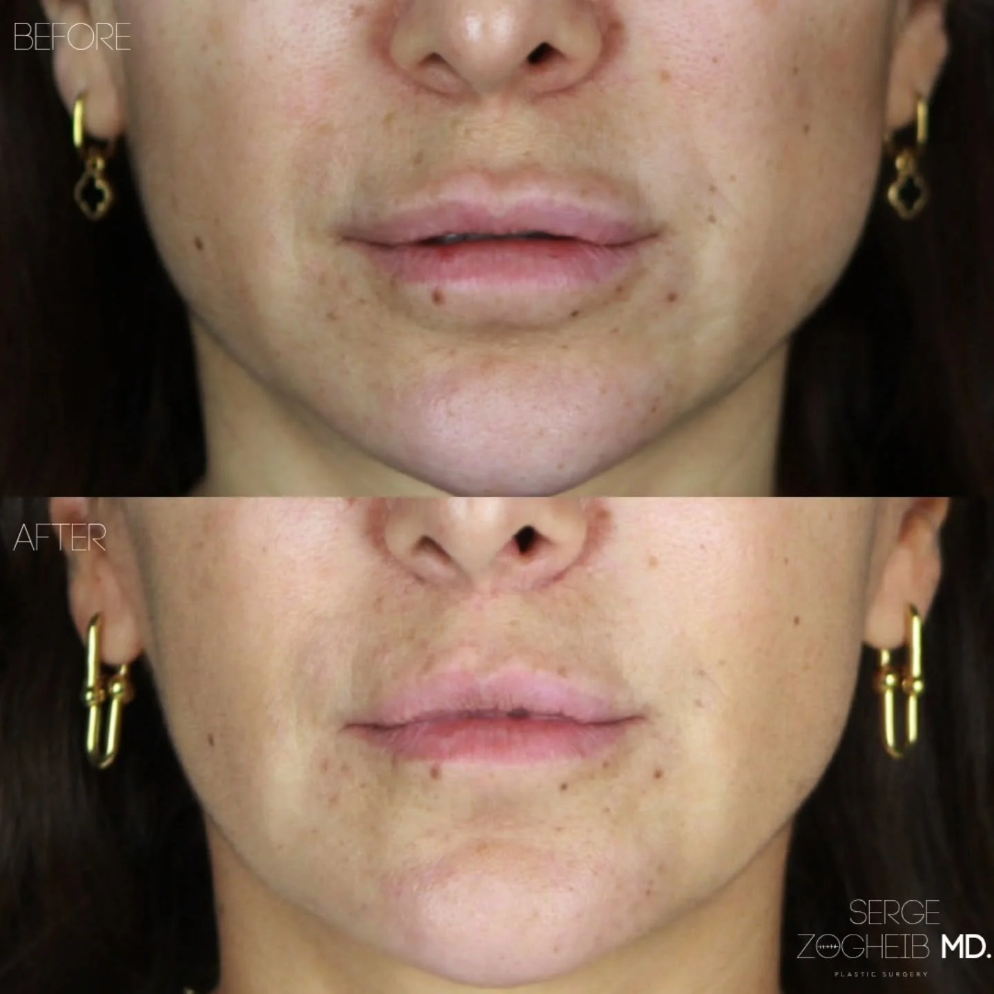 Overfilling and vertical placement of lip filler above the vermilion border can create the “duck lip” effect (fillers are seen as bumps in the picture above and below the lip).
For this patient, I first dissolved the excess product to re