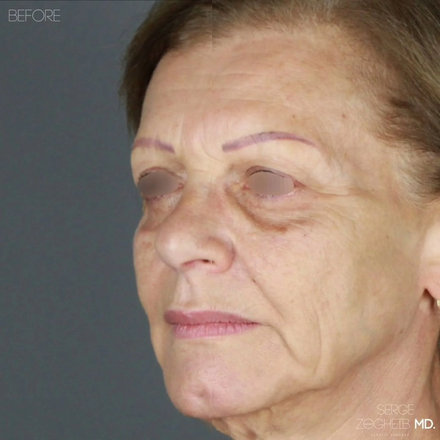 A facelift doesn’t have to look “done.”
This is an early 3-week result after a secondary deep plane facelift, necklift and brow lift.
Even with residual swelling and the normal red scars at this point (they fade), the improvement