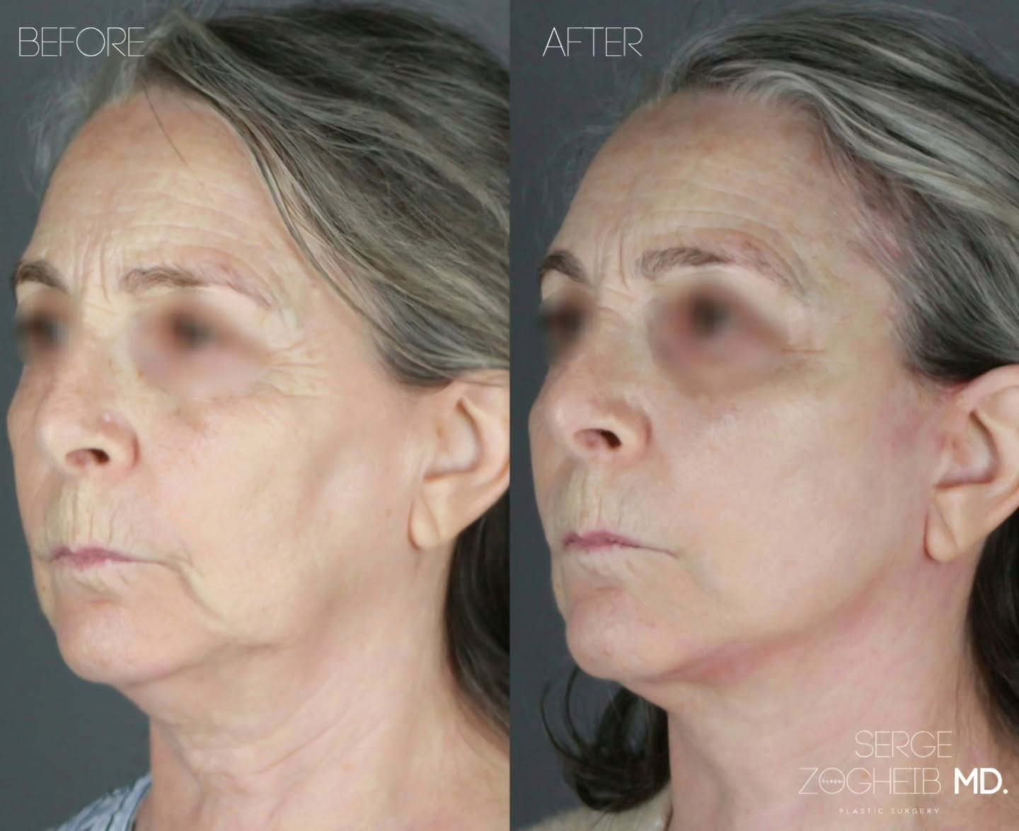 Who says there&rsquo;s an age limit on confidence?
10 weeks after a deep plane facelift + neck lift + brow lift (the big three), and she&rsquo;s just getting started (at 70 years old) !

At this stage, swelling is still resolving, scars are still a b