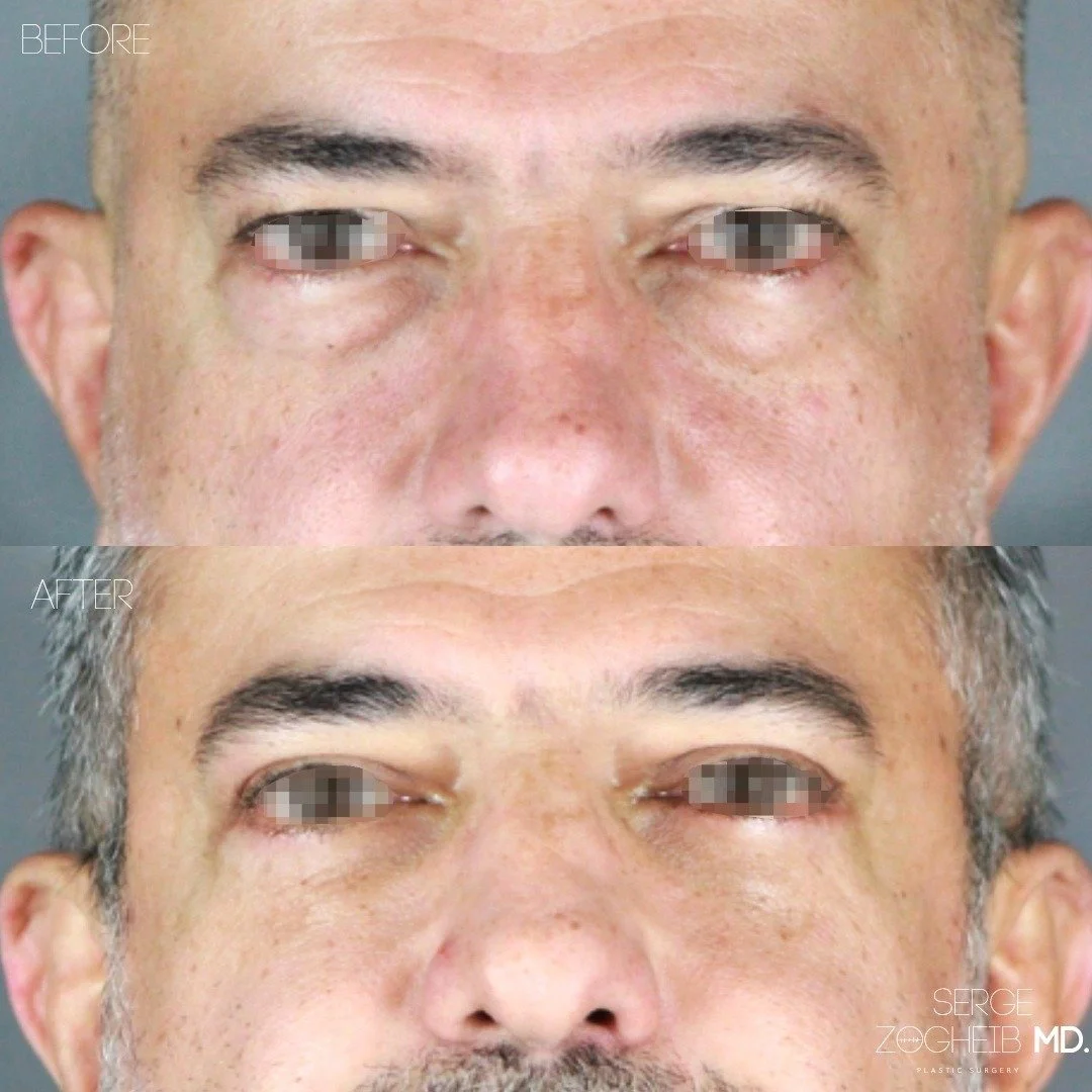 The eyes are often the first place to show aging.

In this case, the issue wasn&rsquo;t just excess skin, it was volume and support. This kind of subtle, structural approach is exactly my style.

I performed a conservative upper #blepharoplasty (key 