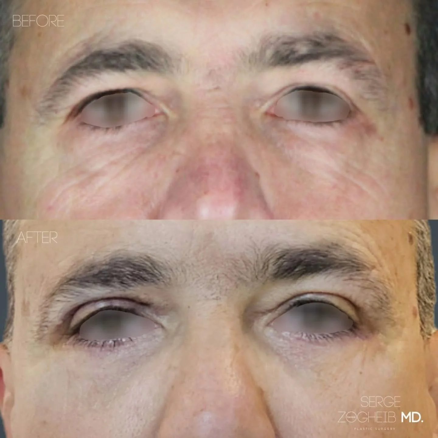 Male eyelid surgery should stay subtle.

In this case, the goal was to reduce heaviness without changing the character of the eyes.

I performed an #upperblepharoplasty for excess skin, and a #lowerblepharoplasty with septal reset.

Instead of removi