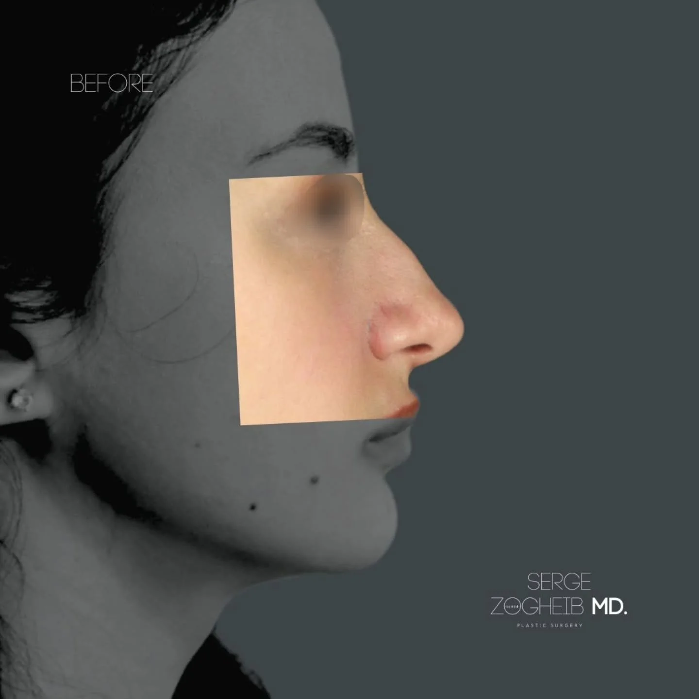 Early rhinoplasty results can be misleading.

At this stage, what you see is not the final result.

After surgery, it&rsquo;s normal to notice:

&bull; Swelling, especially in the tip (it often looks larger and less defined)
&bull; Slight over-rotati