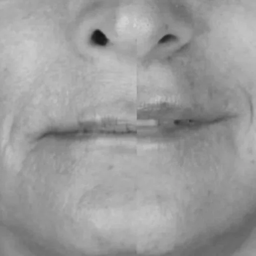 Lip Lift: A Measurement-Driven Approach to Upper Lip Shortening