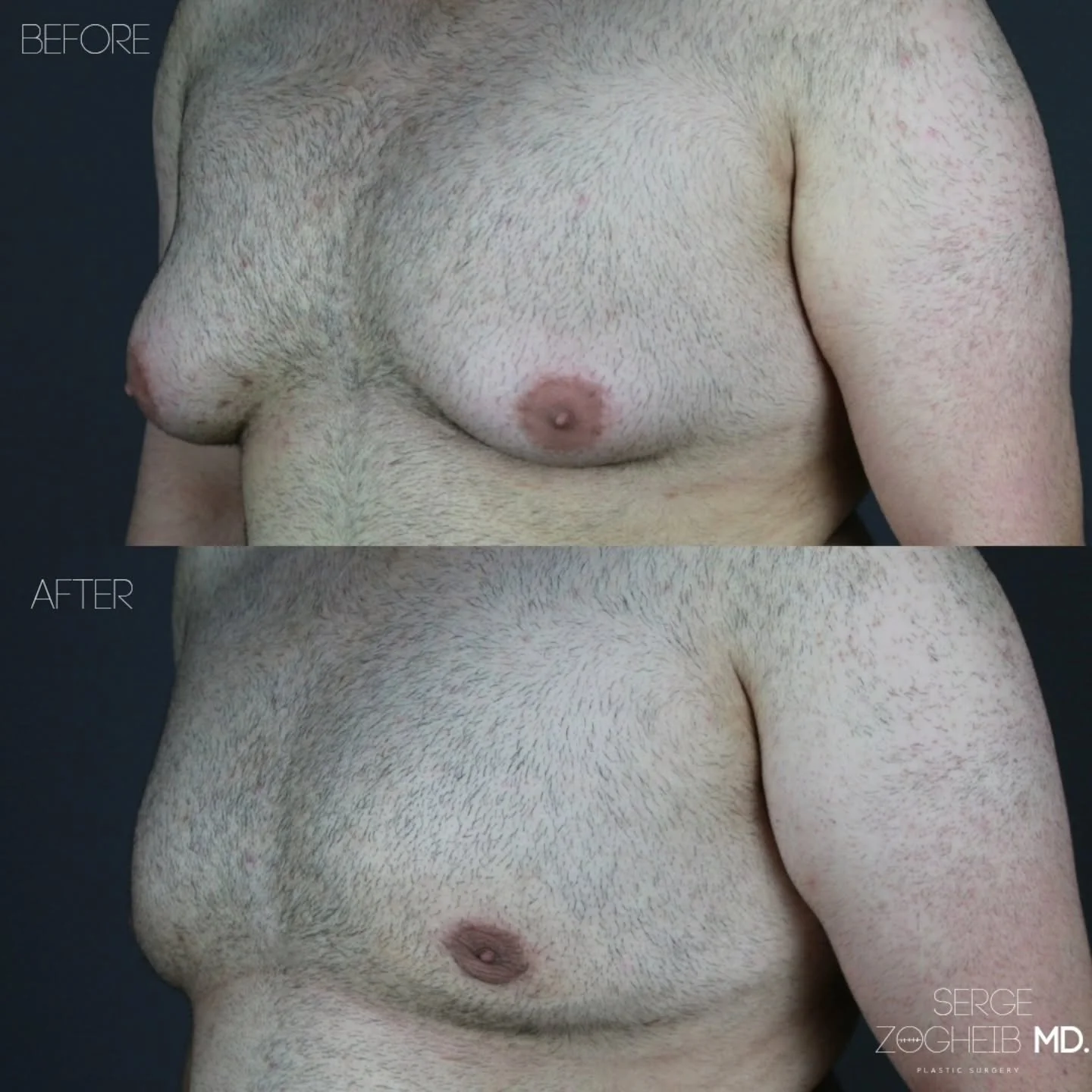 In this #gynecomastia case, I combined liposuction and gland excision with energy-based skin tightening rather than jumping directly to large skin excisions and longer scars.

The chest skin often continues to retract and tighten for months after sur