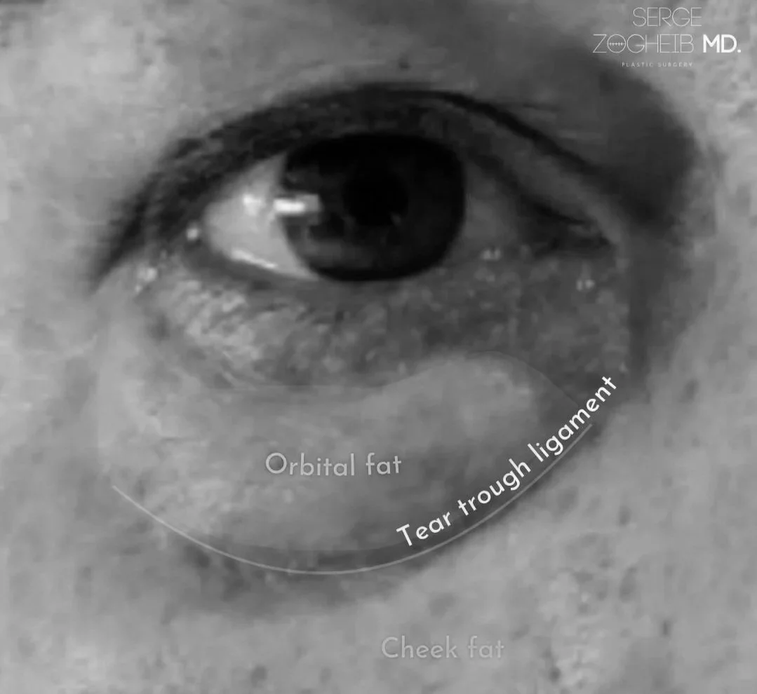 Why I Rarely Use Hyaluronic Acid Filler in the Tear Trough