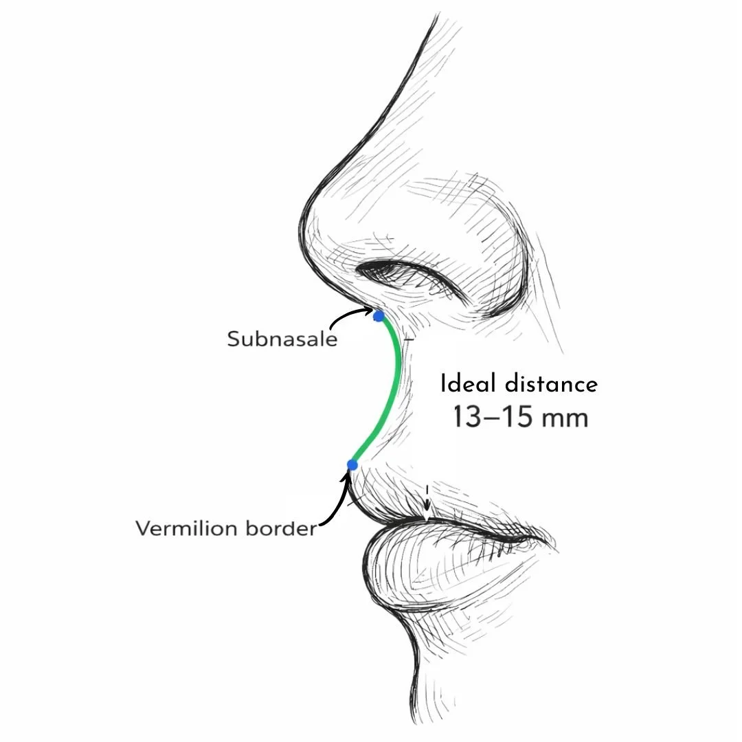 Ideal subnasale to vermilion distance