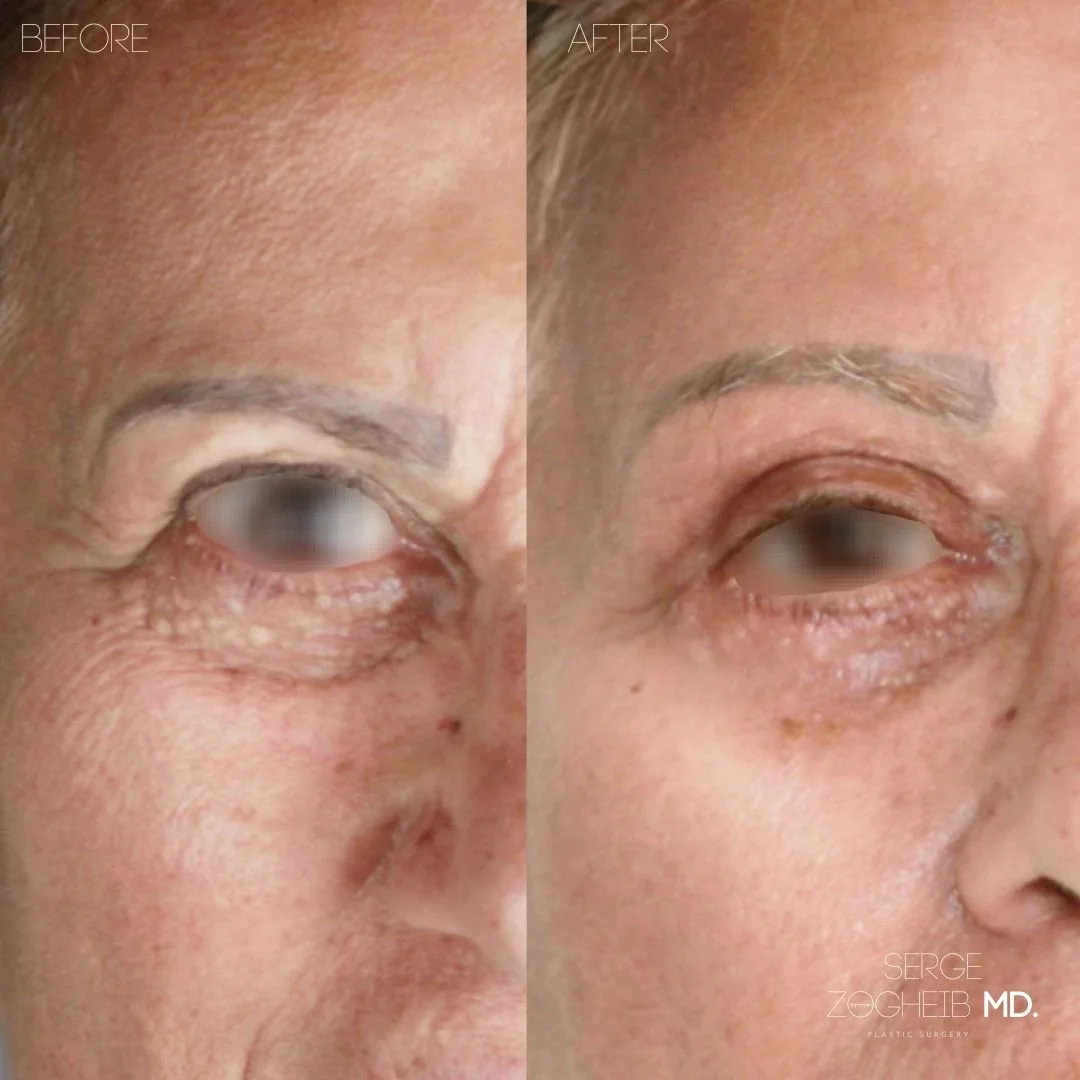 A before and after picture of an upper and lower blepharoplasty and a deep temporal brow lift