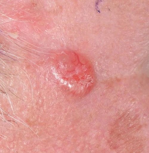 Basal cell carcinoma, red nodule on the skin