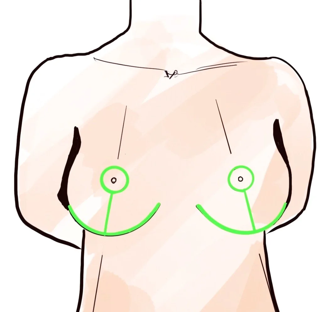 Breast mastopexy scars