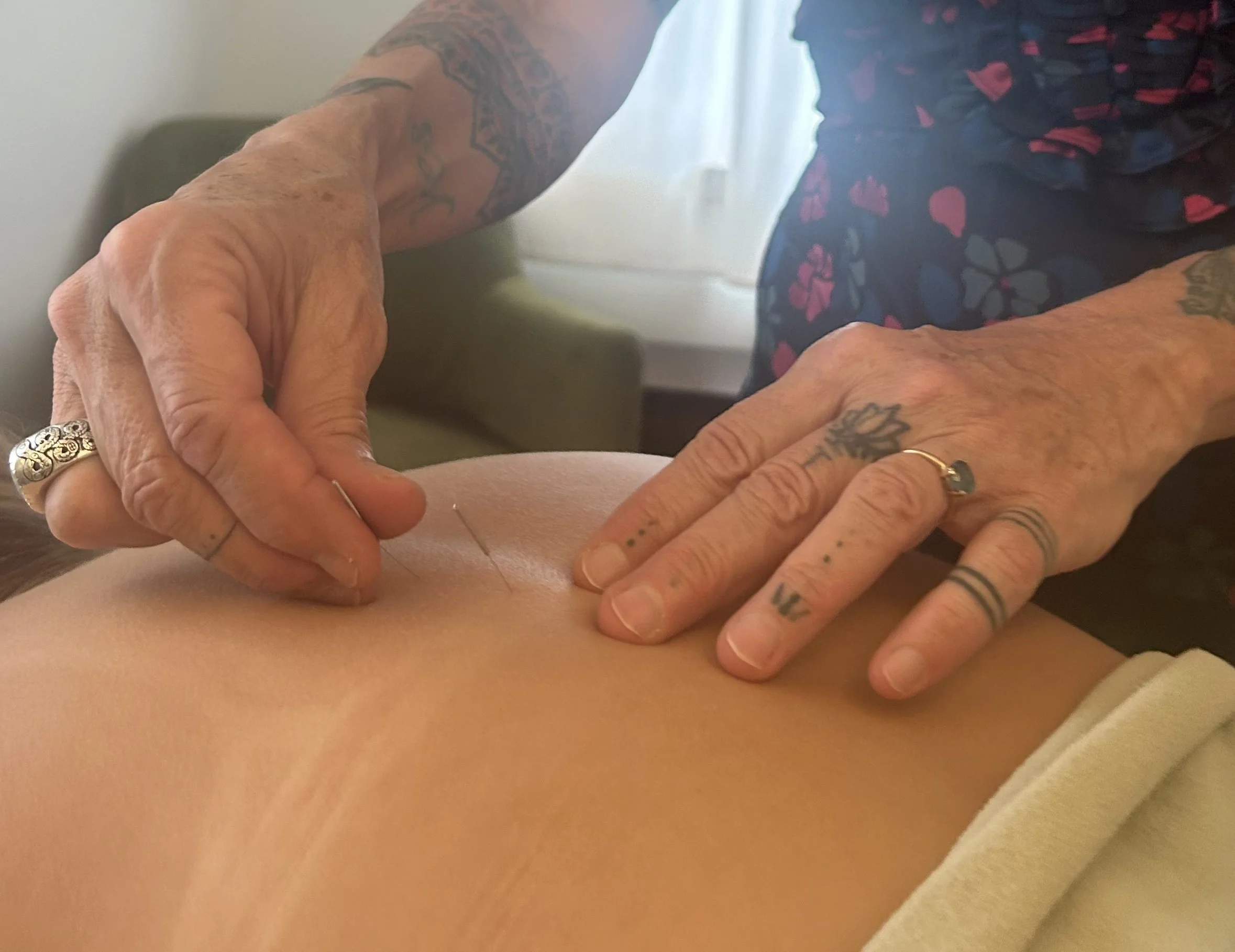 Close-up of acupuncture needles being inserted into skin by hands.