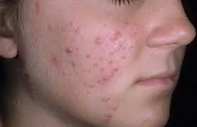 Nutrition for Acne