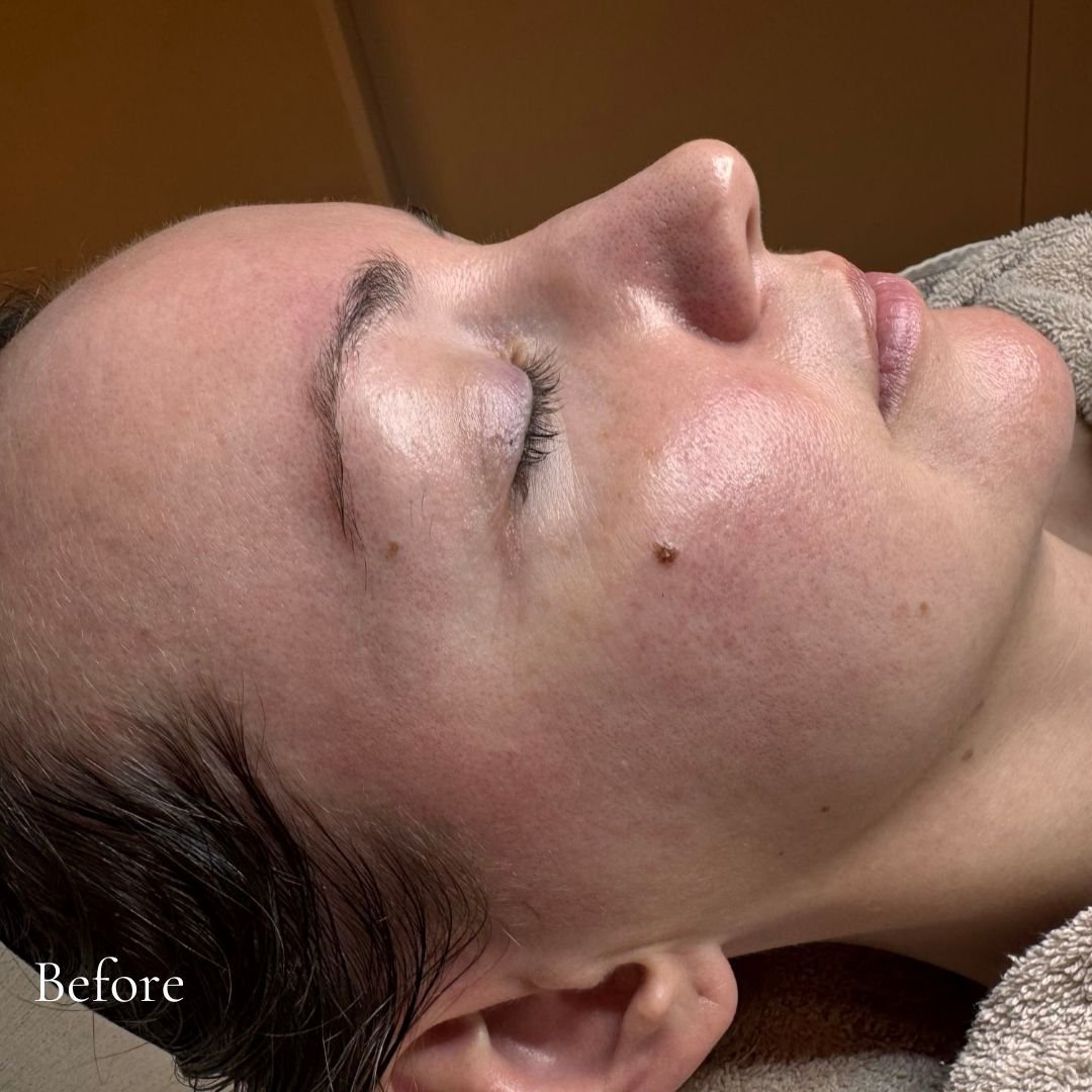 ✨ Voor &amp; Na bij V-Cosmetics ✨

Deze lieve klant wilde haar gezonde kleur &amp; glow terug en werken aan een huid met meer volume, terwijl roodheid en pigmentvlekjes verminderd zouden worden.
Na slechts 2 behandelingen is het resultaat verbluffend