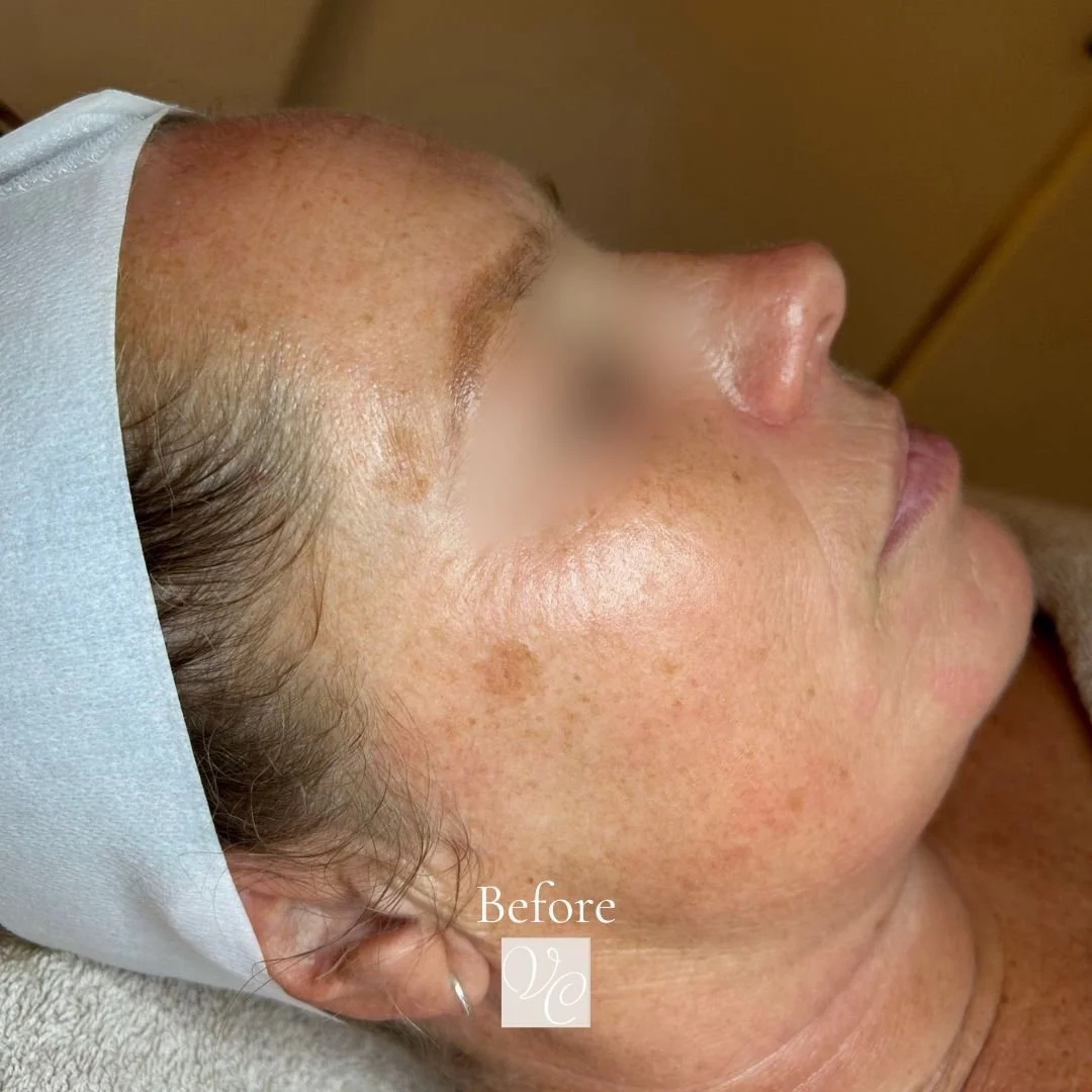✨ Bij deze lieve klant mochten we werken aan haar pigmentproblemen met een prachtig resultaat als eindresultaat 🤍

Wil jij ook werken aan jouw mooiste, meest egale huid? ☀️
Met ons Pre Summer Event zet jij de eerste stap richting &eacute;chte huidve