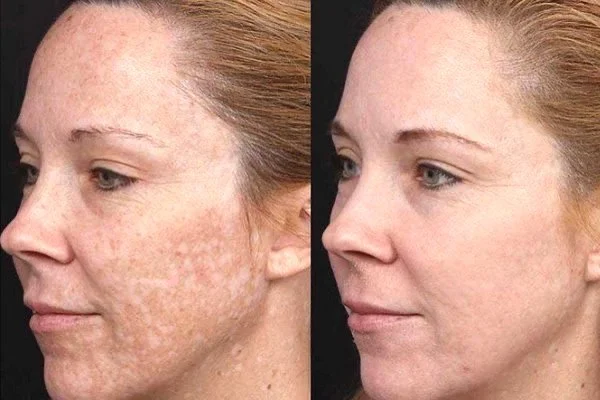 Pigmentatie bij V-cosmetics