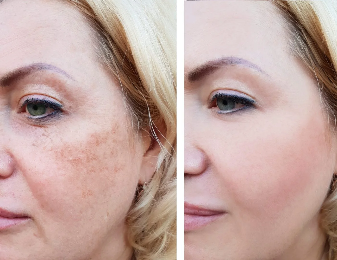 Pigment behandeling bij V-Cosmetics