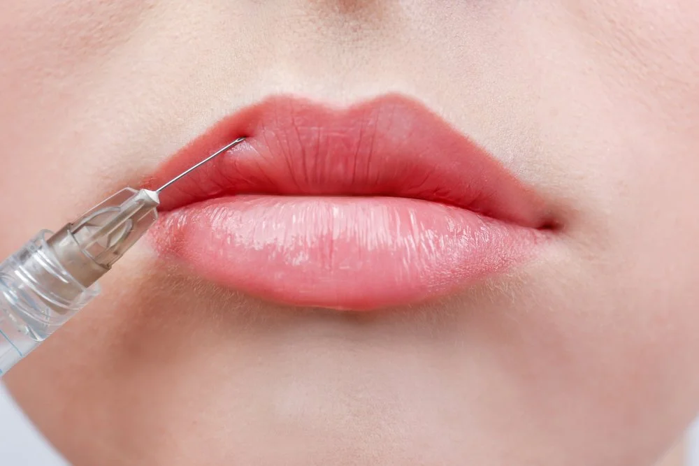 Lipfiller bij V-Cosmetics Rotterdam