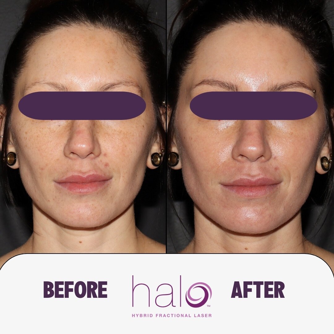 From Dull to Dazzling: The Halo Glow Transformation ✨

This client's remarkable transformation was achieved with the HALO Laser Treatment, expertly performed by Nurse Natalie. Our client's journey from dull, uneven skin to radiant, glowing complexion