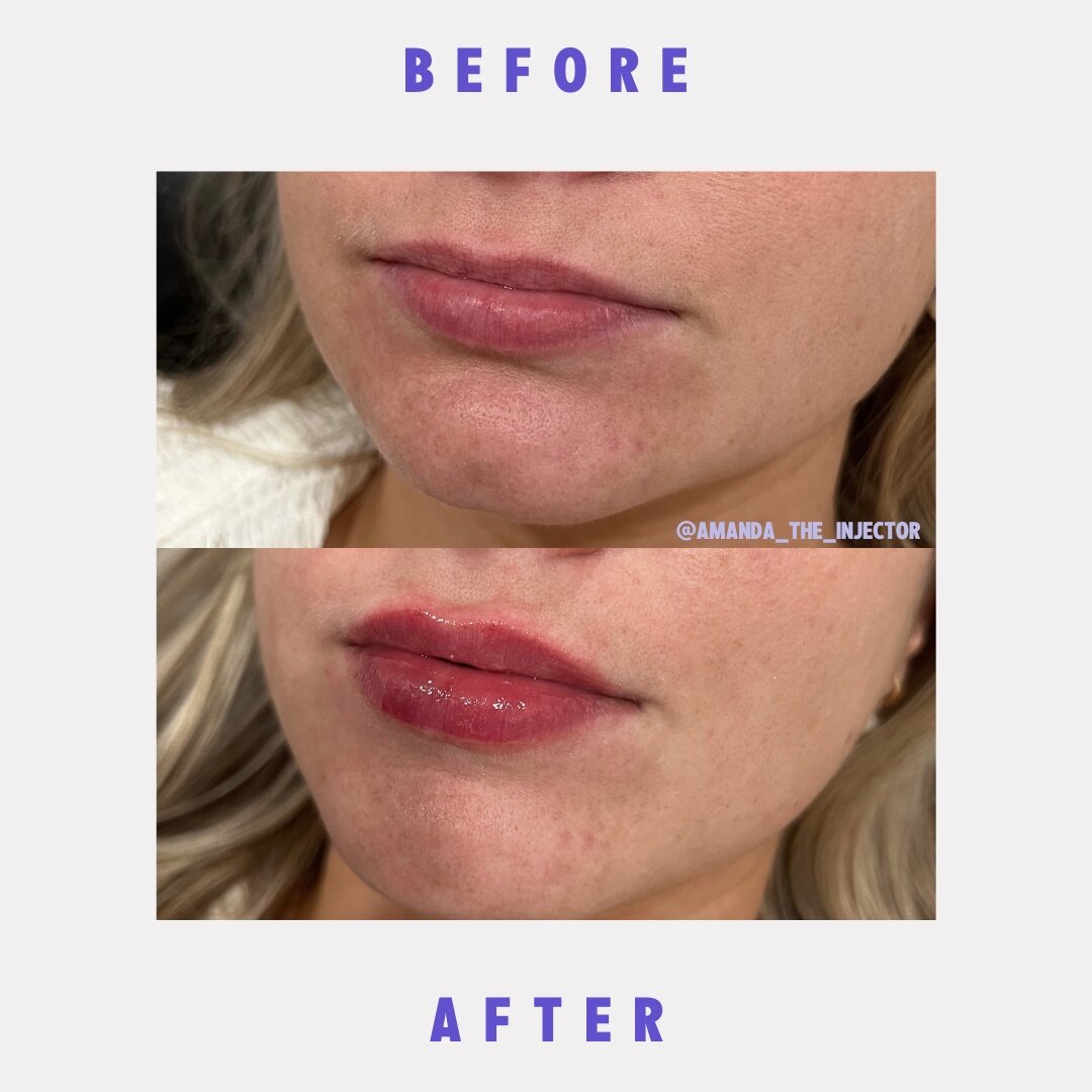 Check out this stunning transformation! 💋✨ Witness the magic of JUV&Eacute;DERM Volbella as Nurse Amanda works her artistry to create a beautifully rejuvenated pout. It's truly amazing what a difference a little enhancement can make! Ready to elevat