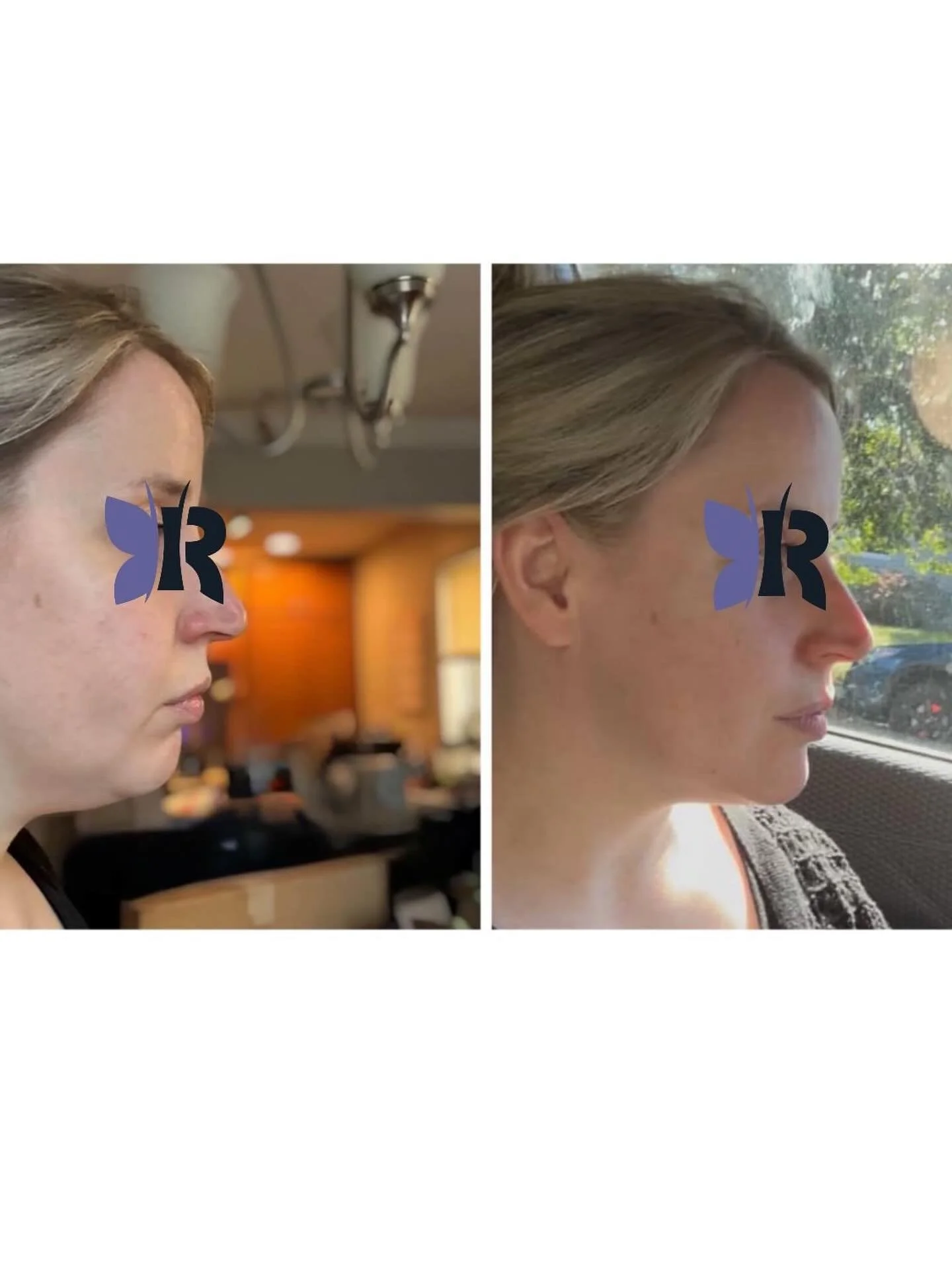 ✨ Natural. Balanced. Beautiful. 

Check out these incredible facial balancing results by @nurse_mia using JUV&Eacute;DERM dermal fillers to enhance the jawline and chin - creating harmony and structure without surgery.

This subtle but powerful trans