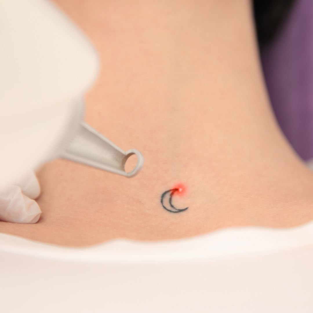 How laser tattoo removal works  Goodbye Tattoos