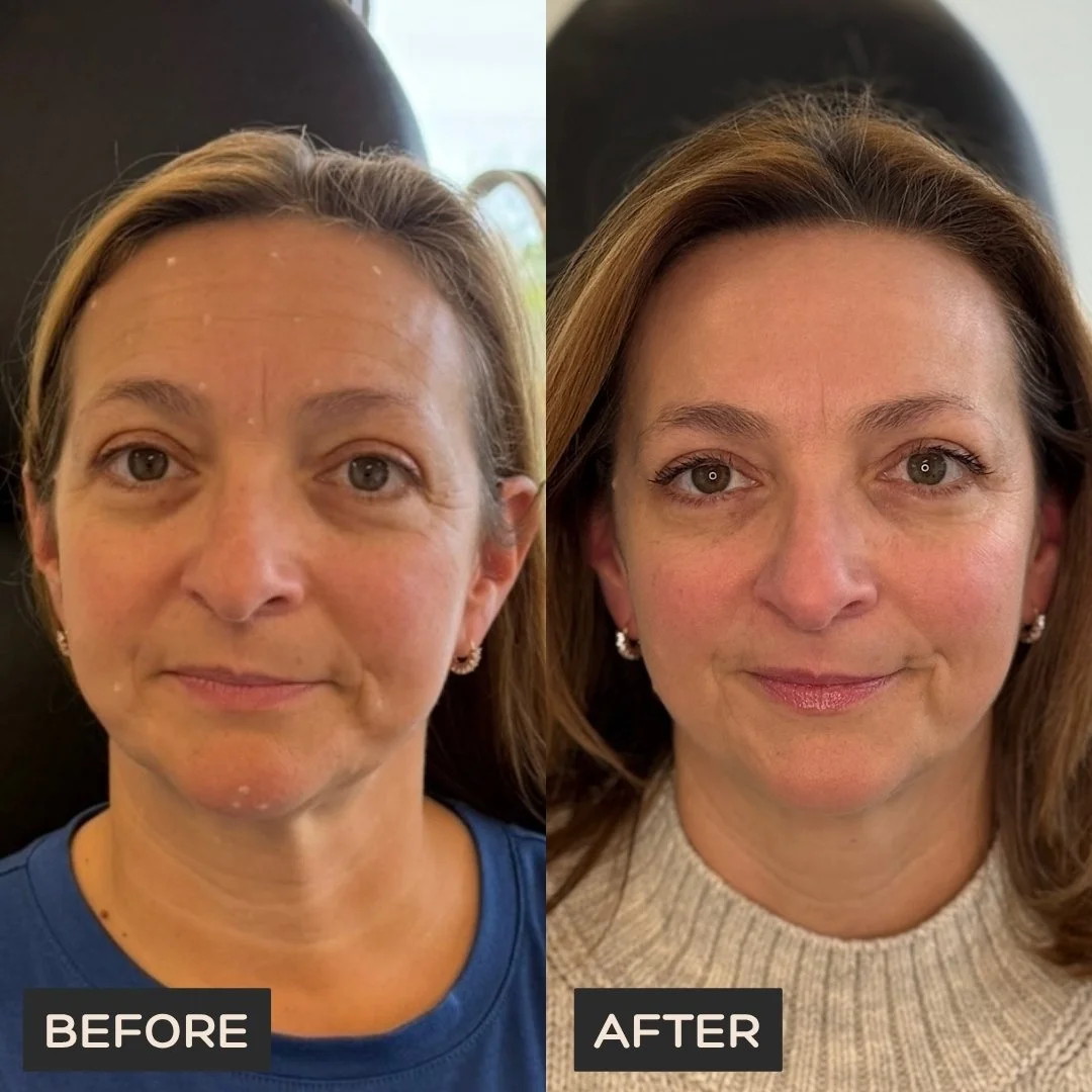 Female client before Neurotoxin and PRX with microneedling treatment at Morph Med Spa in Ridgefield, CT – visible forehead, brow, and overall skin texture