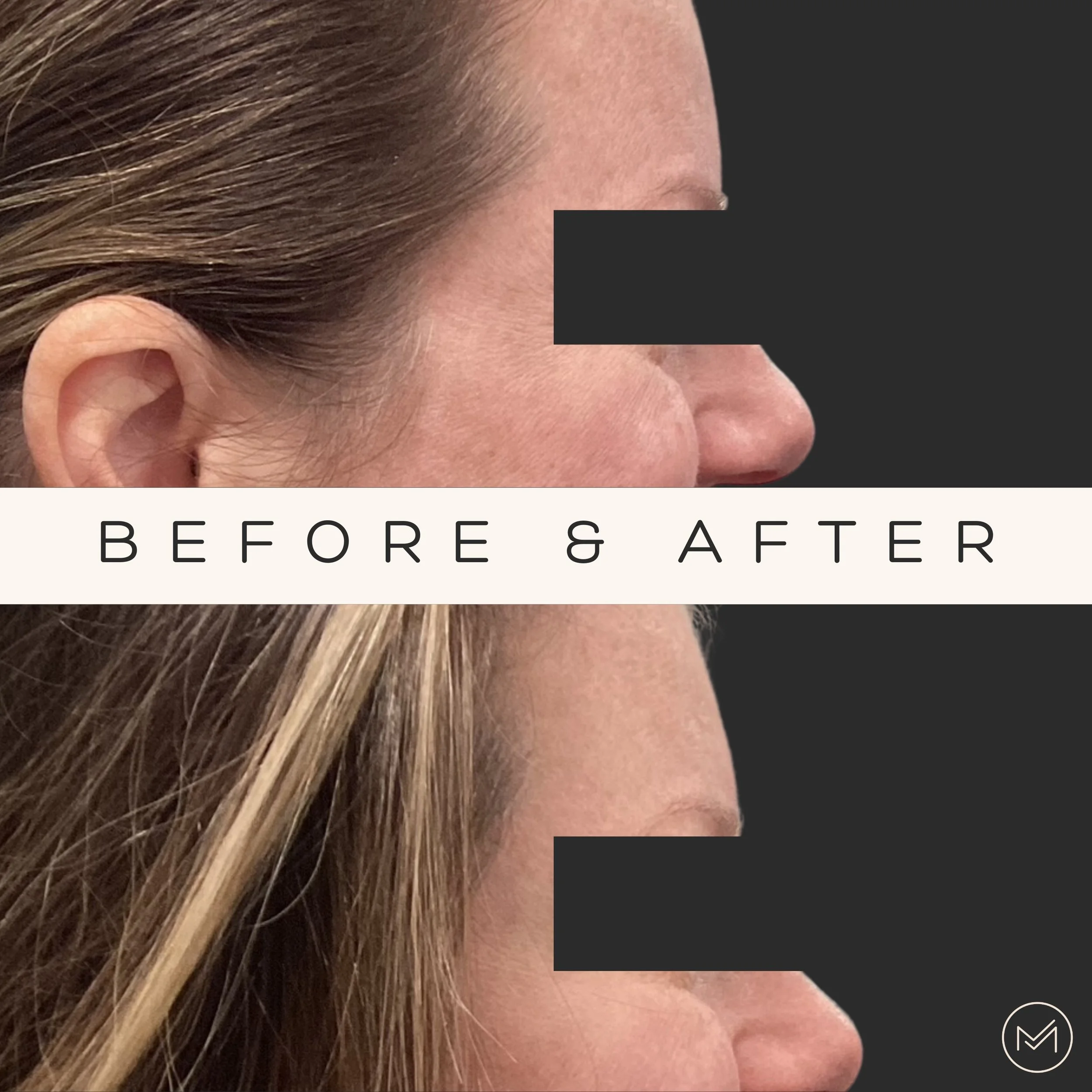 Side-by-side comparison of a woman's face before and after a cosmetic procedure, focusing on the nose and cheek area, with the label 'BEFORE & AFTER' in the center.