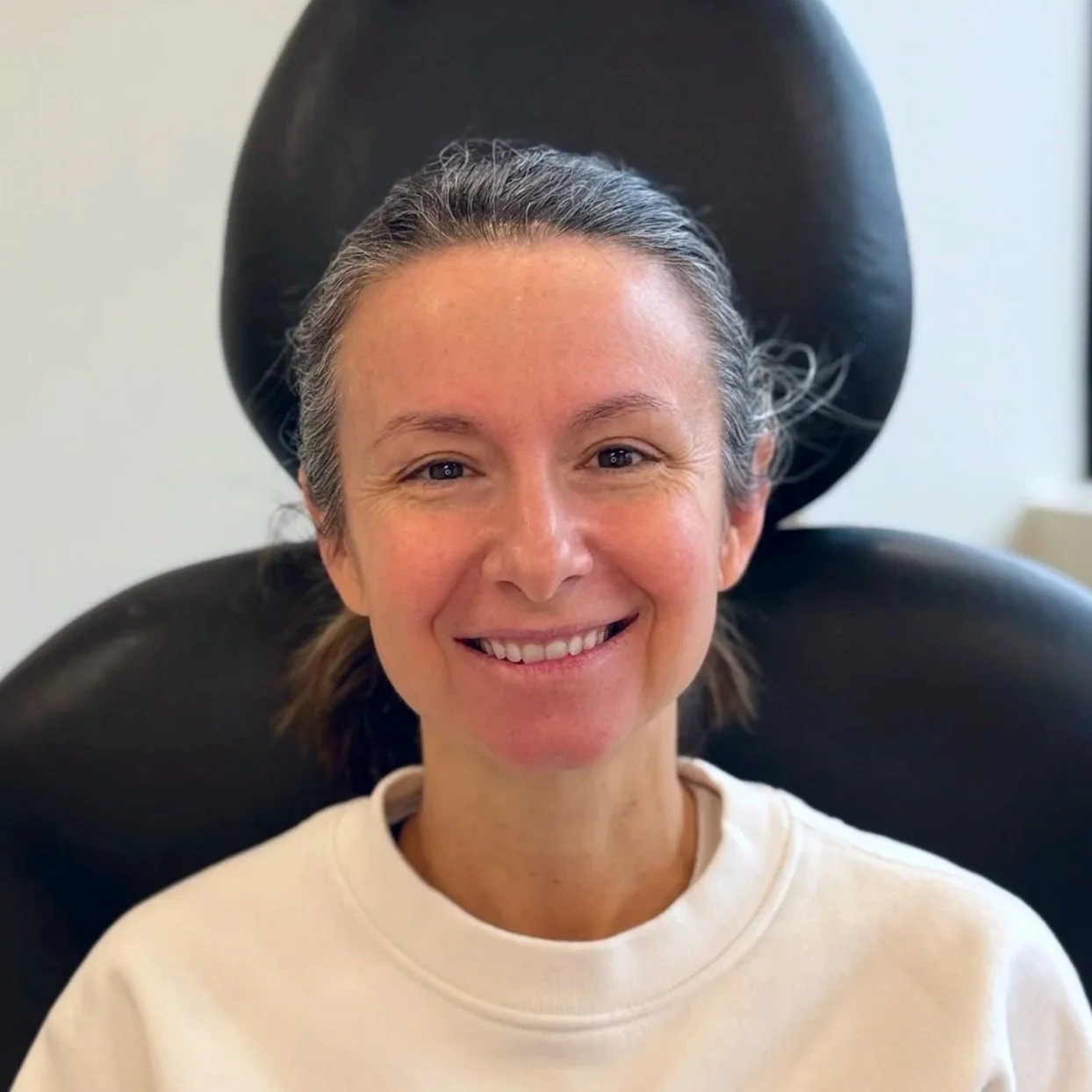 Female client before Neurotoxin treatment at Morph Med Spa in Ridgefield, CT — visible expression lines on forehead and around eyes
