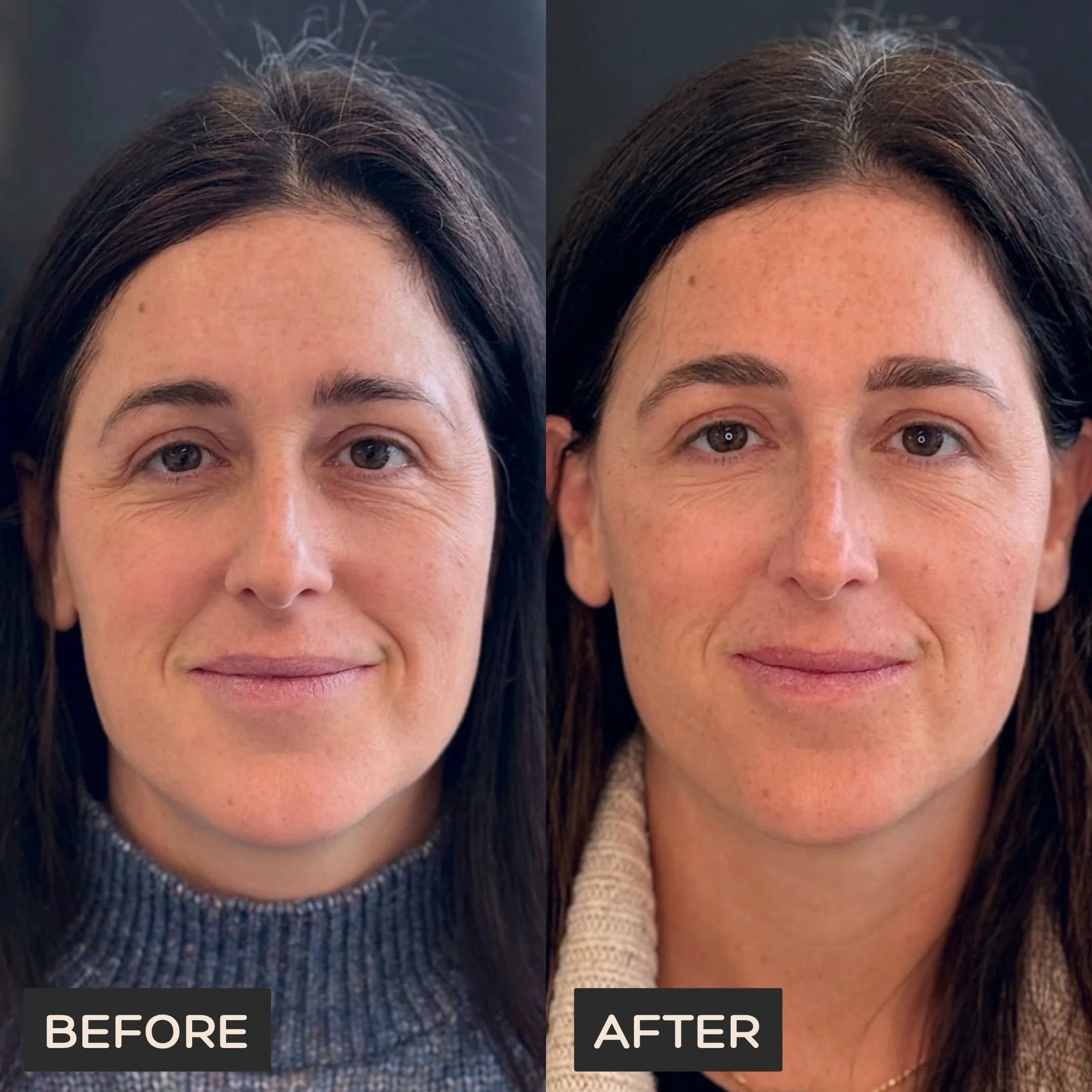 Female client before Neurotoxin treatment at Morph Med Spa in Ridgefield, CT — visible expression lines on forehead and around eyes