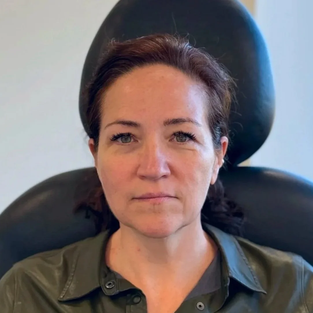 Female client before Sculptra and Neurotoxin treatment at Morph Med Spa in Ridgefield, CT — visible volume loss in midface and cheek area