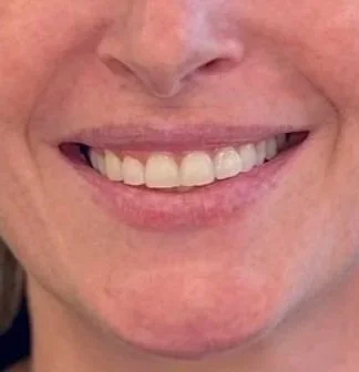 Female client before lip filler treatment at Morph Med Spa in Ridgefield, CT – close-up of lips before treatment