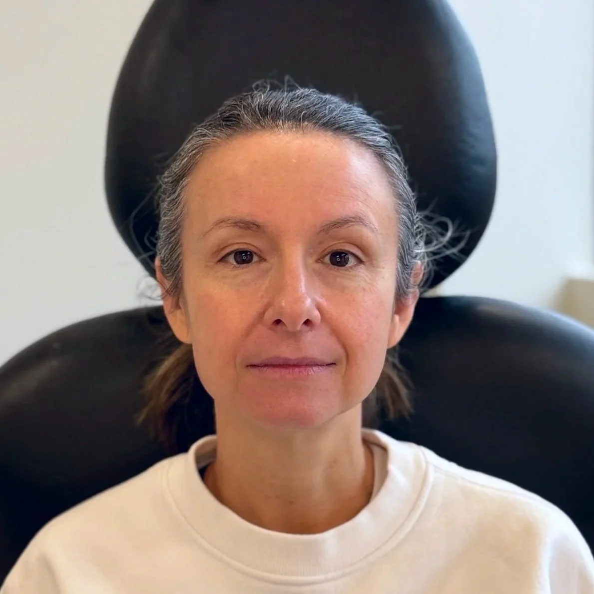 Female client before Neurotoxin treatment at Morph Med Spa in Ridgefield, CT — visible forehead and brow lines
