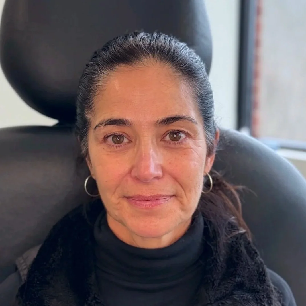 Female client before Neurotoxin treatment at Morph Med Spa in Ridgefield, CT – visible forehead, brow, and eye-area expression lines