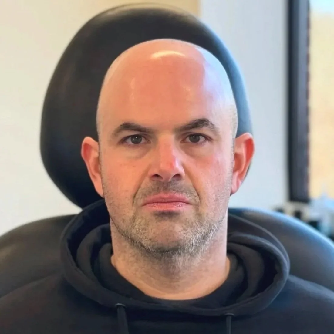 Male client after Radiesse and Neurotoxin treatment at Morph Med Spa in Ridgefield, CT — restored midface volume and smoother forehead