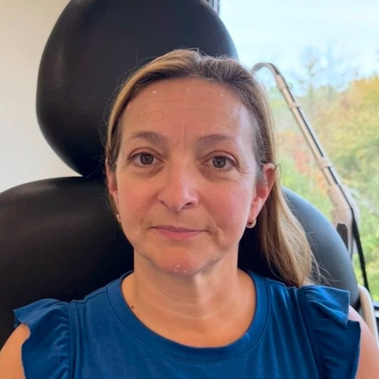 Female client before Neurotoxin and PRX with microneedling treatment at Morph Med Spa in Ridgefield, CT – visible forehead, brow, and overall skin texture