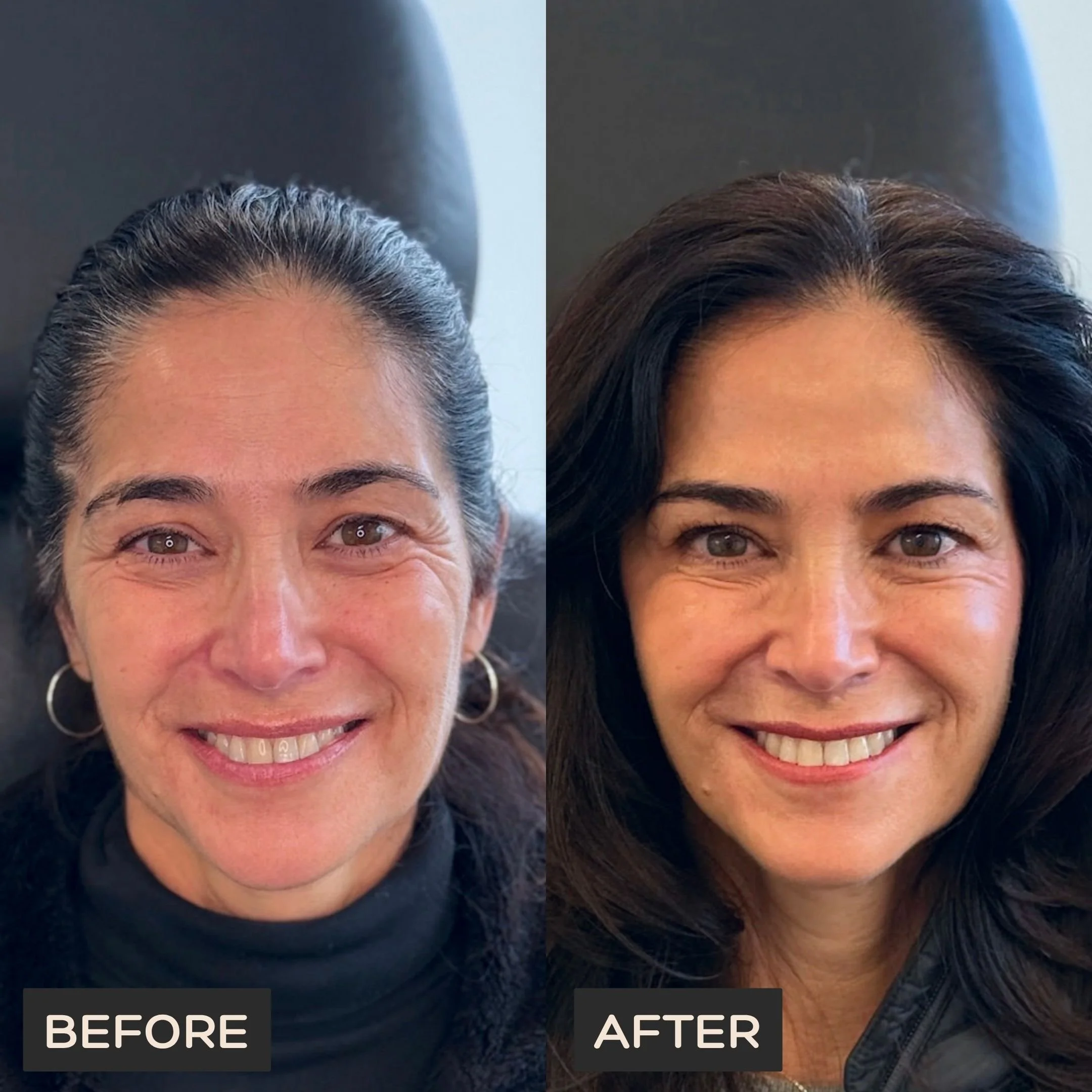 Female client before Neurotoxin treatment at Morph Med Spa in Ridgefield, CT – visible forehead, brow, and eye-area expression lines