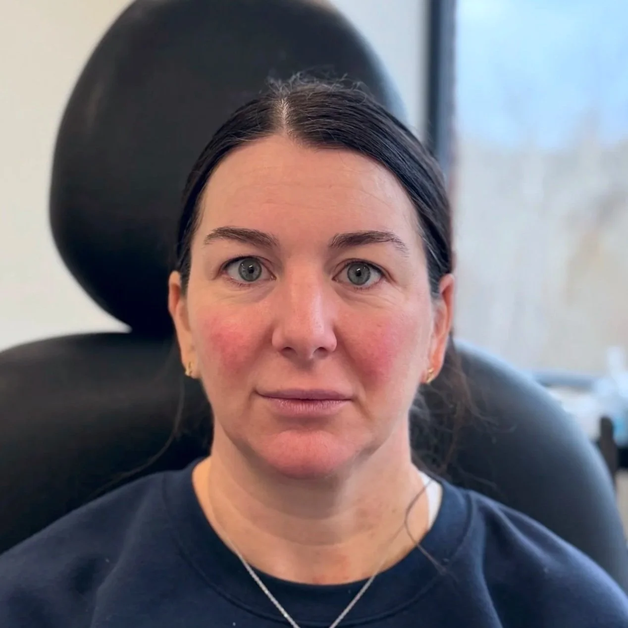 Female client before Neurotoxin treatment at Morph Med Spa in Ridgefield, CT – visible forehead, brow, and eye-area expression lines