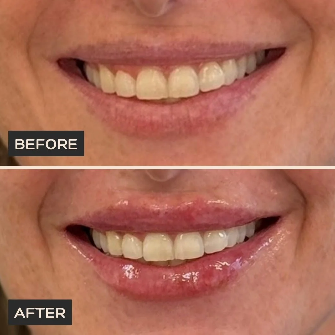 Female client before lip filler treatment at Morph Med Spa in Ridgefield, CT – close-up of lips before treatment