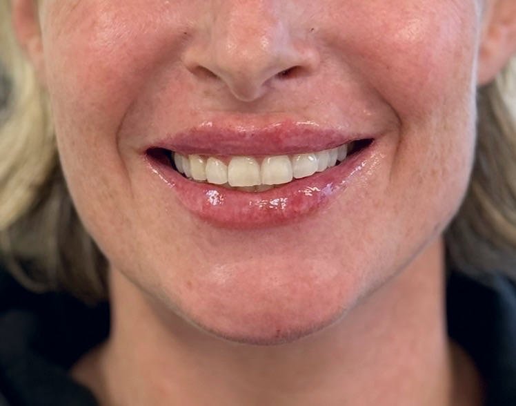 Female client after lip filler treatment at Morph Med Spa in Ridgefield, CT – close-up of lips with enhanced volume and shape